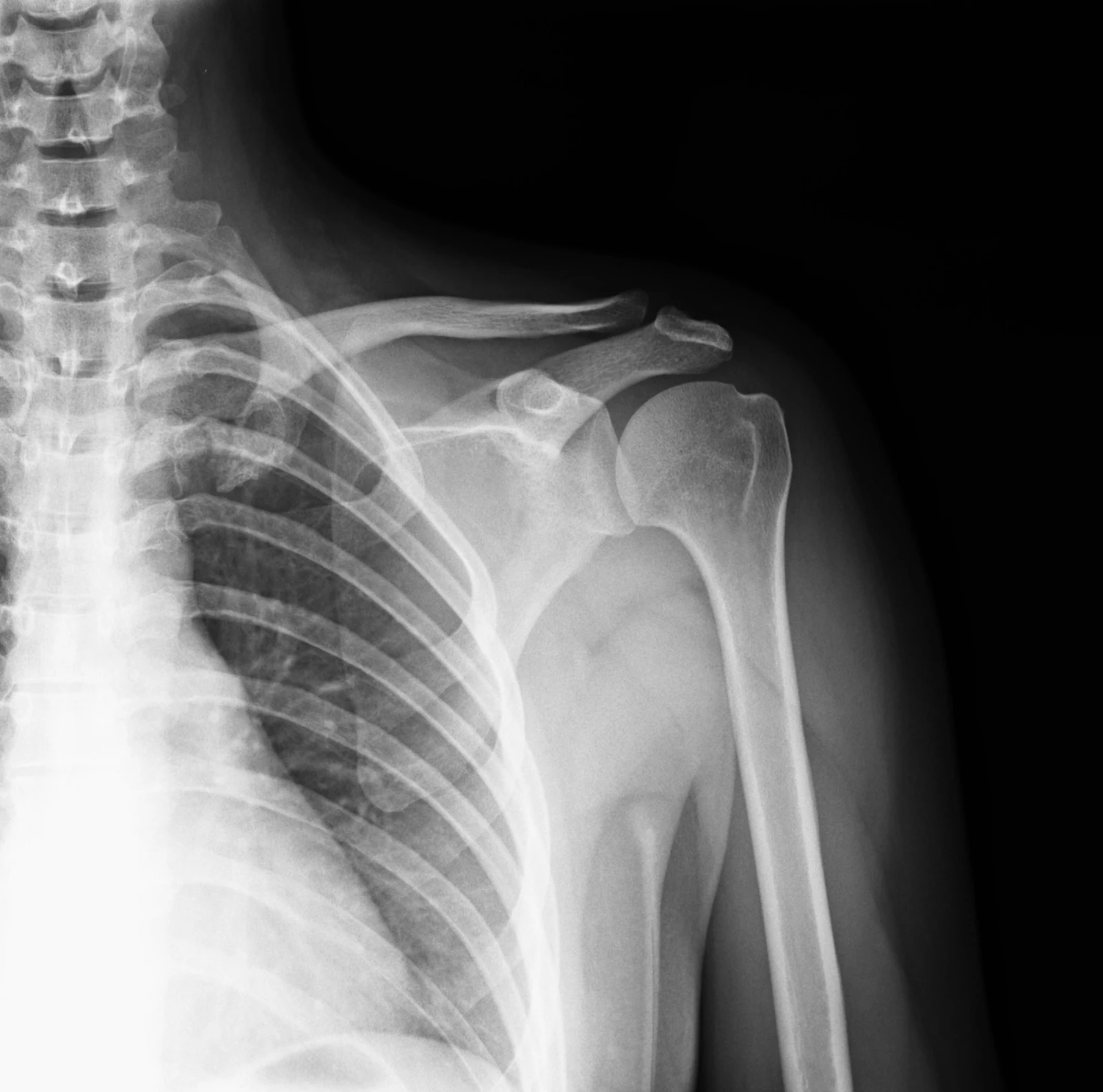 An X-ray image of a human shoulder and upper arm